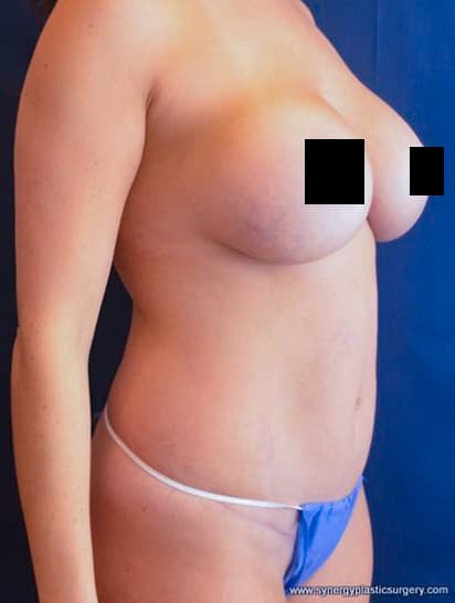 Before Mommy Makeover