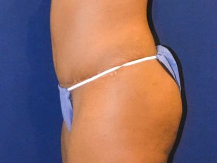 After Tummy Tuck