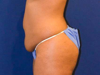 Before Tummy Tuck