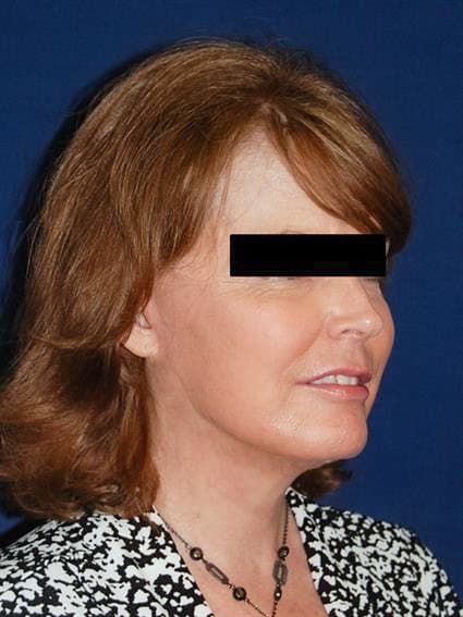 After Facelift