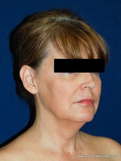 Before Facelift