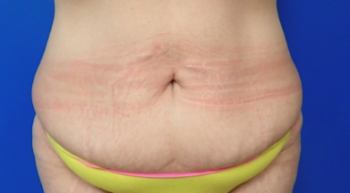 Mommy makeover, including tummy tuck, at Synergy Plastic Surgery in Austin, TX