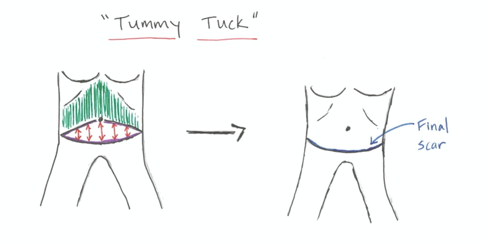 Tummy tuck at Synergy Plastic Surgery in Austin, TX.