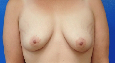 Breast lift patient before photo at Synergy Plastic Surgery in Austin.