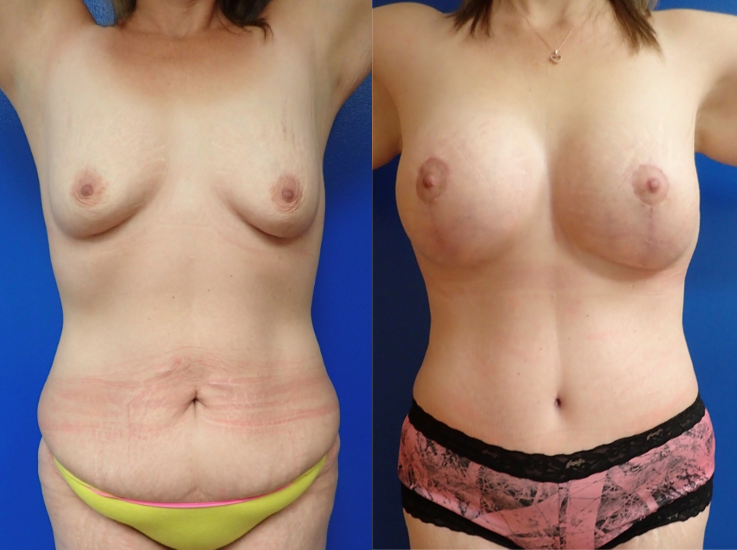 Mommy makeover patient, including breast lift in Austin.