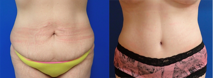 Tummy tuck and liposuction before and after in Austin