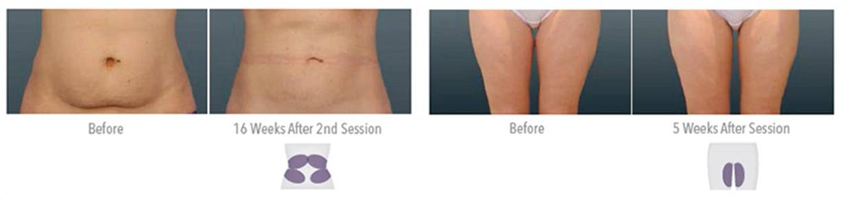 CoolSculpting Before & After