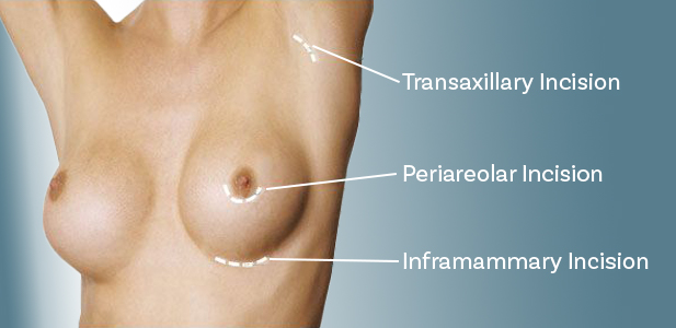 Breast Augmentation Incision Site Options