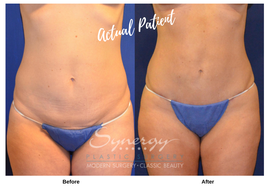 Before and after images of an actual Synergy Plastic Surgery Patient.