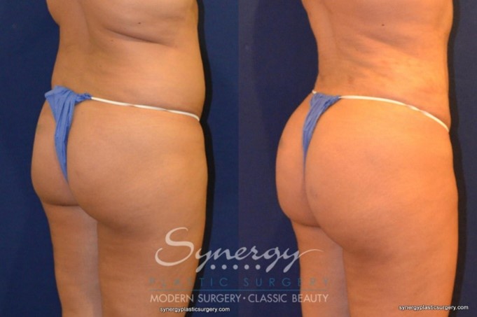 https://www.synergyplasticsurgery.com/content/uploads/2022/02/5.jpg