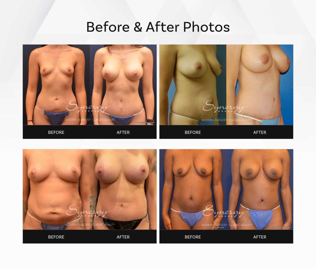 Before and after Mommy Makeover treatment images (actual patients) and a title that reads "Before and After Photos"