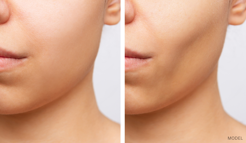 before and after image of buccal fat removal on a woman (model)