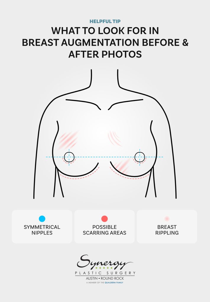 Helpful Tip: What To Look For In Breast Augmentation Before and After Photos. Symmetrical nipples, possible scarring areas, and breast rippling are highlighted in the included diagram.