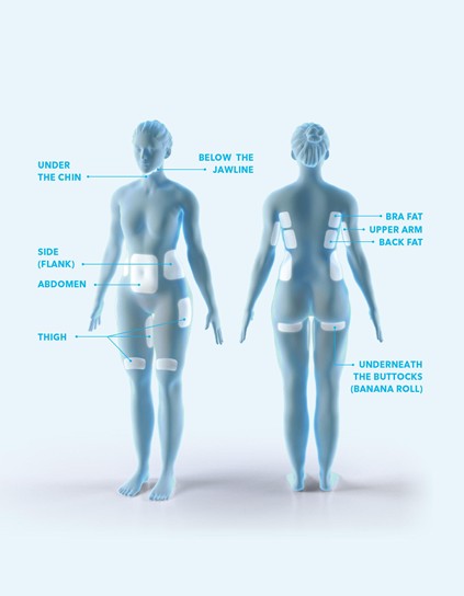 graphic detailing coolsculpting treatment areas